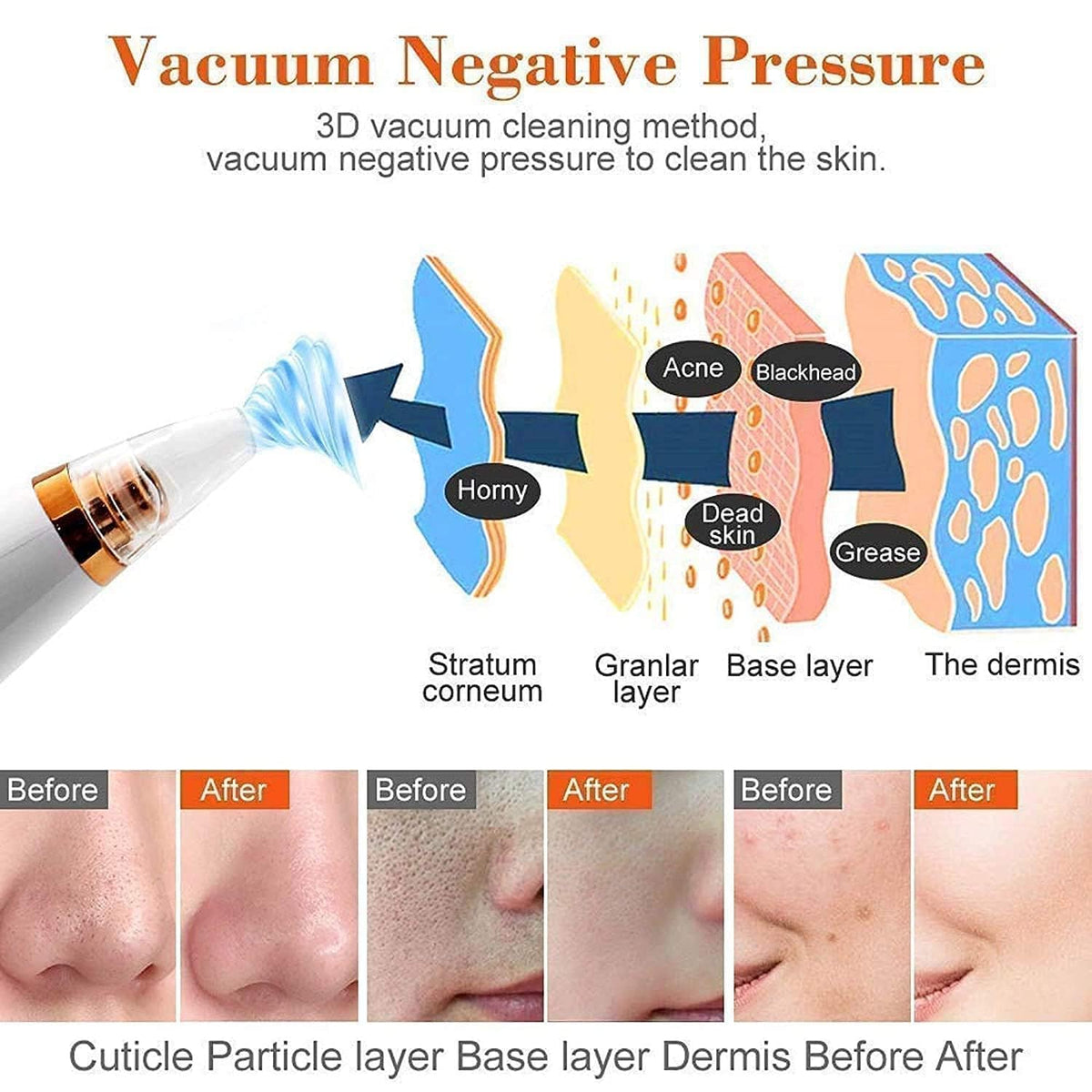 6 in 1 Multi-function Blackhead Remover